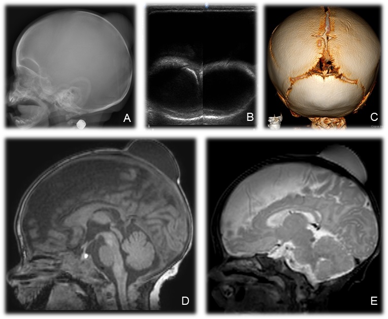 Figure 1. A. X-ray showing increased density and bulging in the high parietal convexity. B. The ultrassound  demonstrated an anechoic collection in extracranial soft tissues. C. 3D reconstruction brain tomography did not demonstrate any abnormality in the cranial vault. D.  (T1 weighted image) and  (3D T2 weighted image): A magnetic resonance imaging of the brain showed similar findings and absence of communication with the intracranial compartment