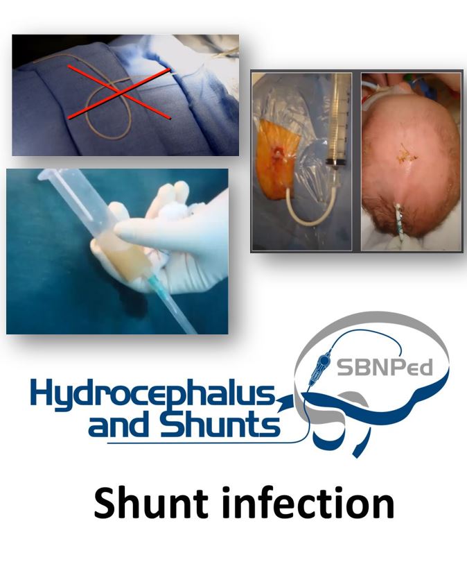 Ventriculo-Gallbladder Shunt